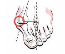 Лечение при вальгусной деформации первого пальца стопы: на что обратить внимание